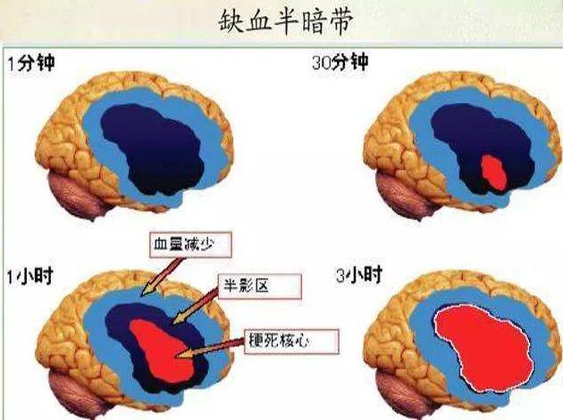 脑梗塞应尽早干细胞治疗