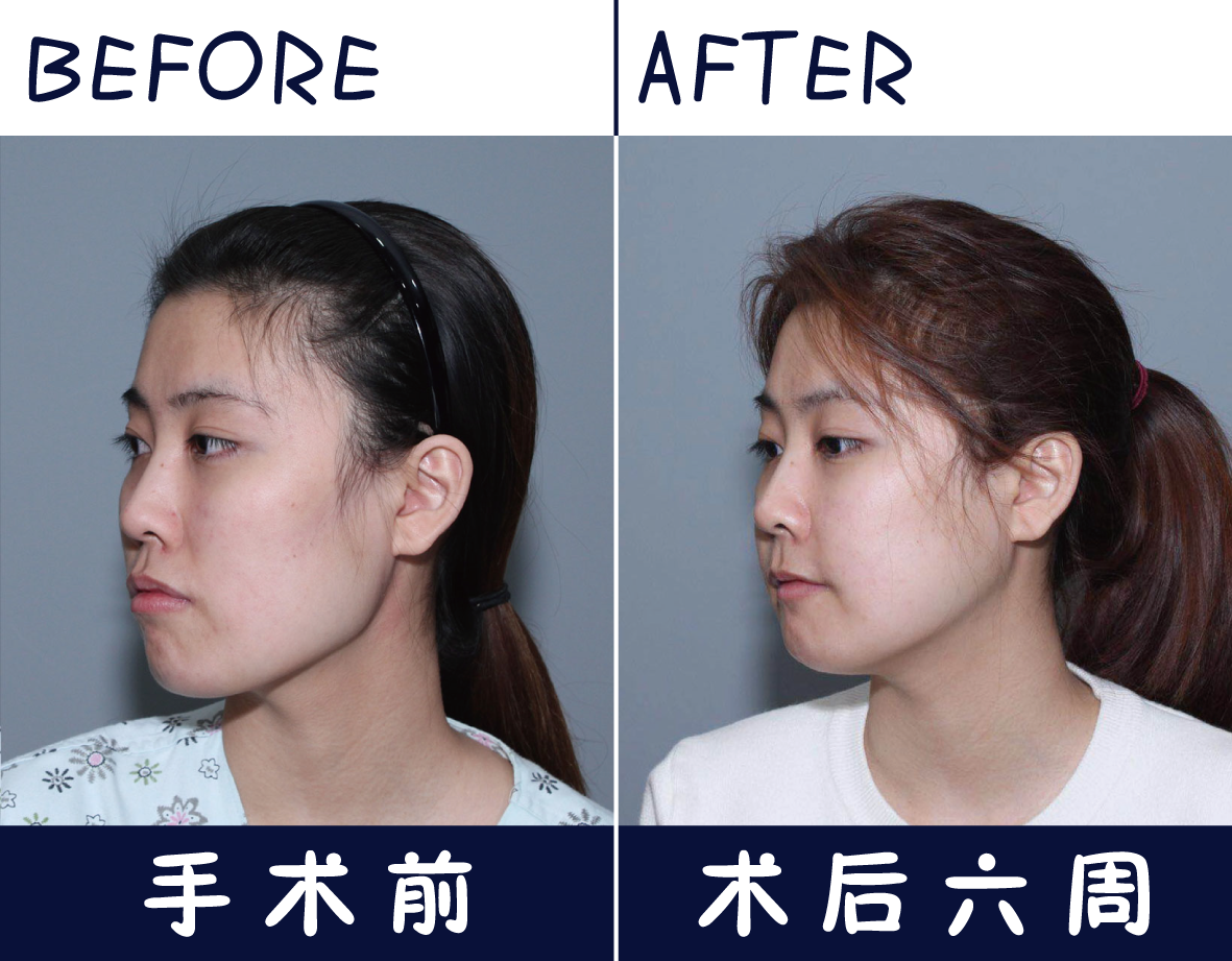 韩国uc首尔牙科突嘴手术案例