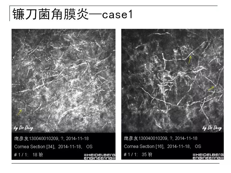 微观,妙不可言——激光共聚焦显微镜下的感染性角膜病