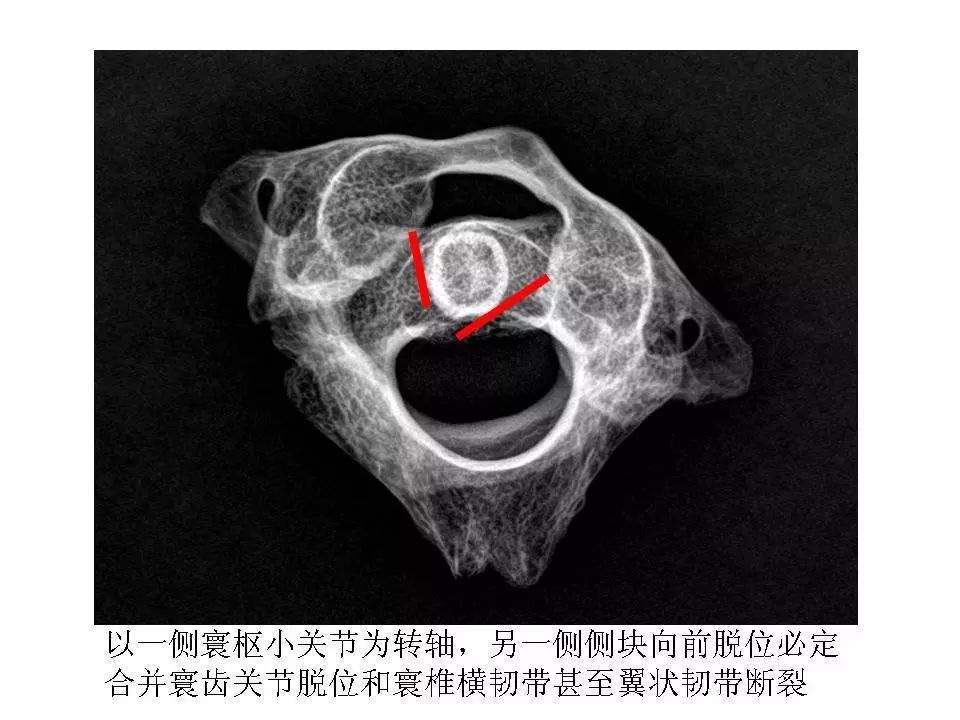 寰枢关节脱位影像诊断 | 影像天地