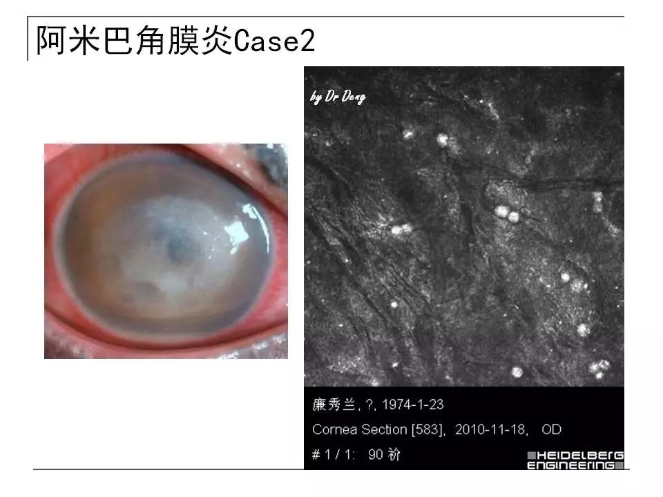 阿米巴角膜溃疡区刮片取材后,可见到不同状态的阿米巴,包括滋养体,囊