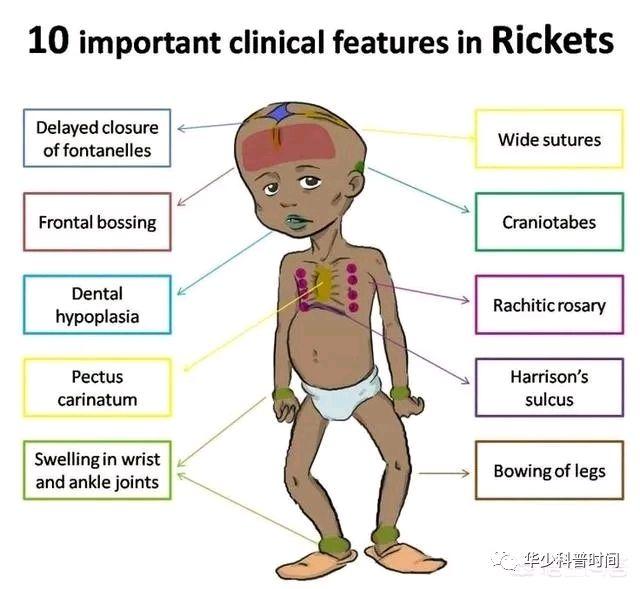 漏斗胸的临床表现与诊断