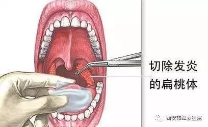 但是扁桃体引起的病症危害远远超过其保护机体免疫力的作用时,不论