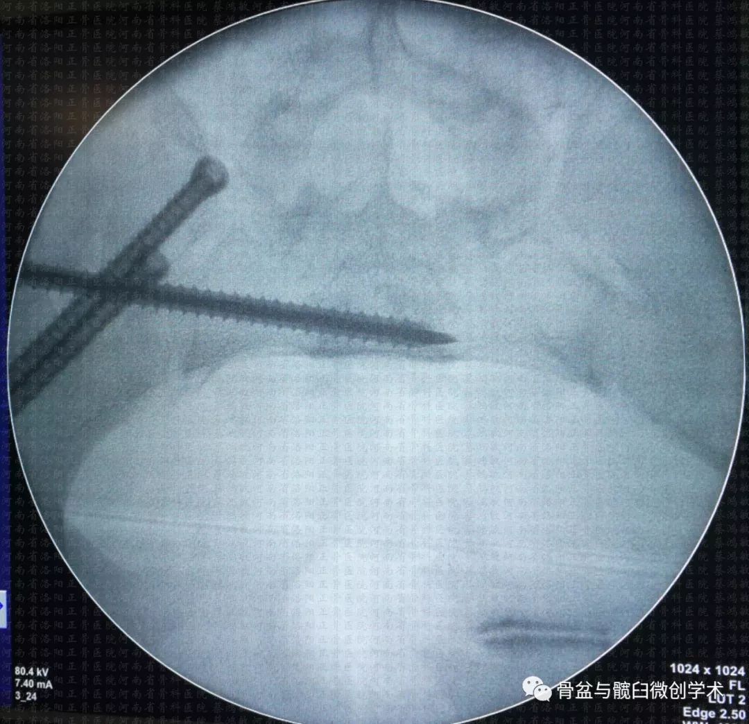 经髂骨骶骨的骶髂关节骨折脱位的微创治疗骶髂螺钉lcii螺钉耻骨上支