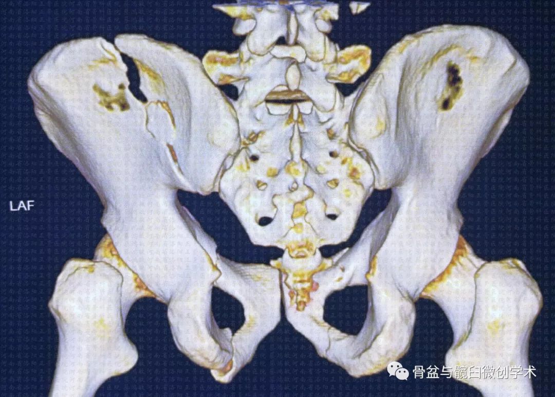 经髂骨&骶骨的骶髂关节骨折脱位的微创治疗:骶髂螺钉