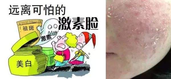 长时间的滥用激素药膏或暗含激素的美容化妆品引起激素脸