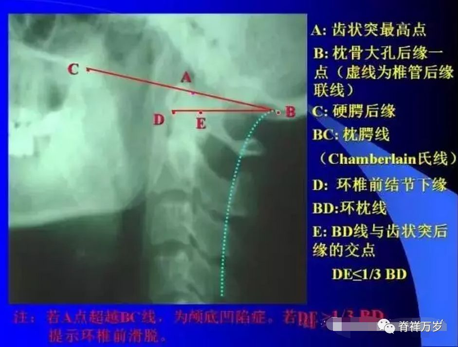 x光片解析颈椎病