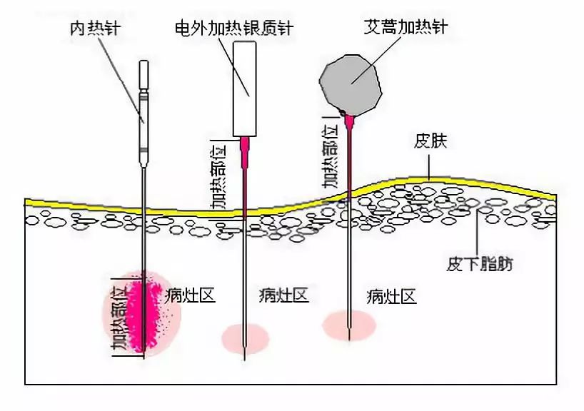 内热式针灸疗法的操作过程,适应症及注意事项分享