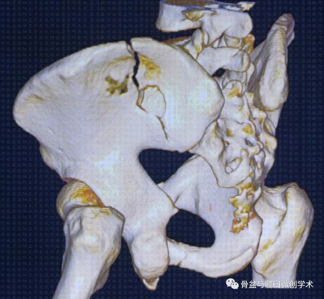 经髂骨&骶骨的骶髂关节骨折脱位的微创治疗:骶髂螺钉