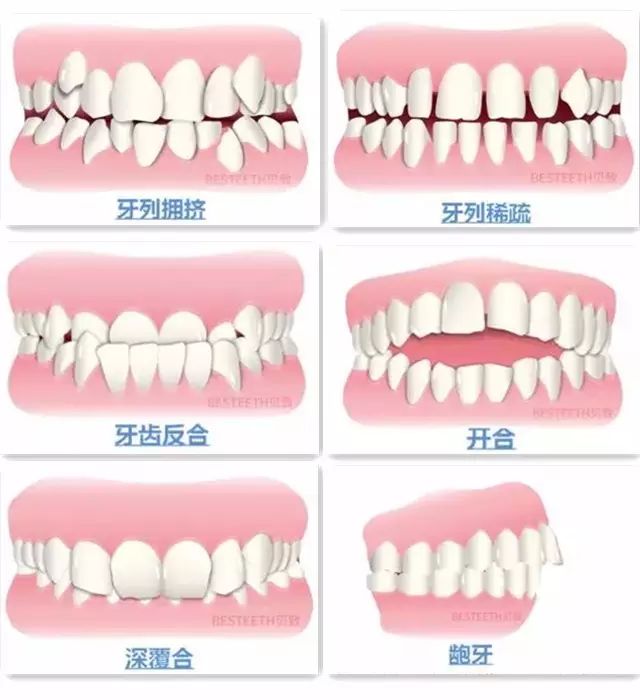 健康 正文  (7)后牙反颌,锁颌:影响牙齿咬合功能,长期可能导致上下颌
