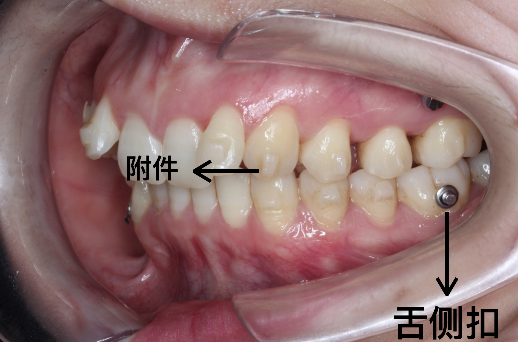 金属舌侧扣,牙套树脂扣的脱落请及时复诊,因为皮圈的使用与治疗效果息