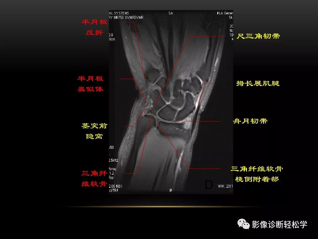 腕关节病变的mri诊断和解剖