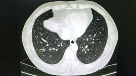 病例讨论vats肺段切除术后支气管胸膜瘘一例