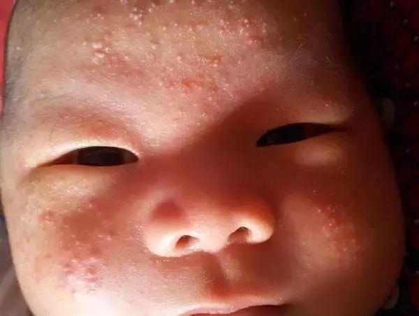                     心疼！湿疹反复折磨宝宝？婴幼儿70%的湿疹，一招就可以治好！
