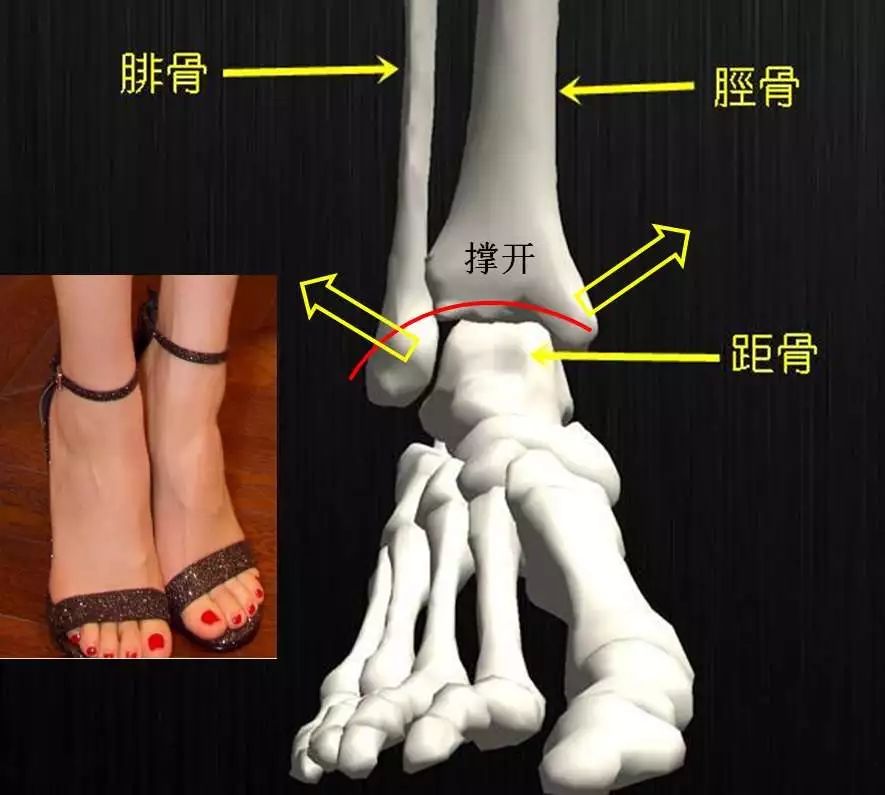 孙医生答复: 踝关节跖屈状态时,距骨会嵌入胫腓骨远端组成的弓,撑开胫