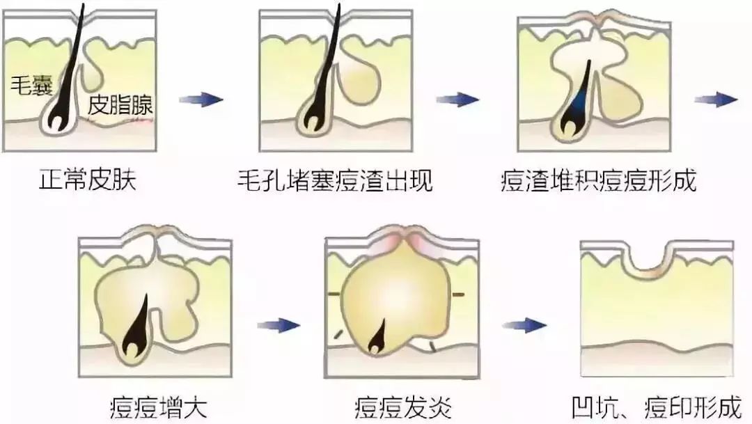 毛孔粗大的原因,根源其实在这里!