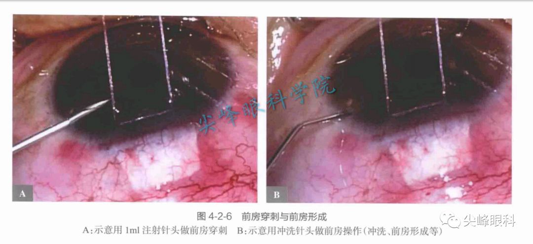 型青光眼急性发作后)的小梁切除术,有时候周切口会被虹膜组织堆积阻塞