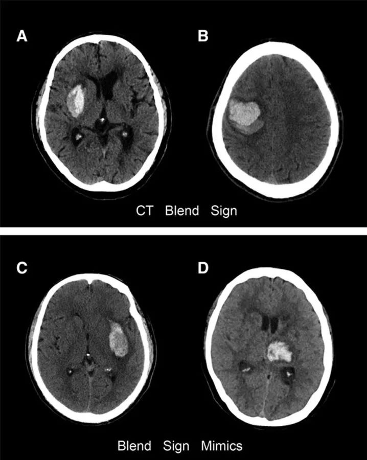 预测自发性脑出血血肿扩大的ct征象,不学就out了!
