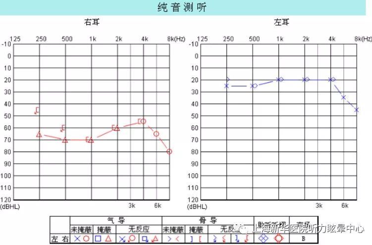 听力图解析系列四梅尼埃病