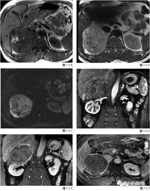 5种肾上腺肿瘤的mri表现