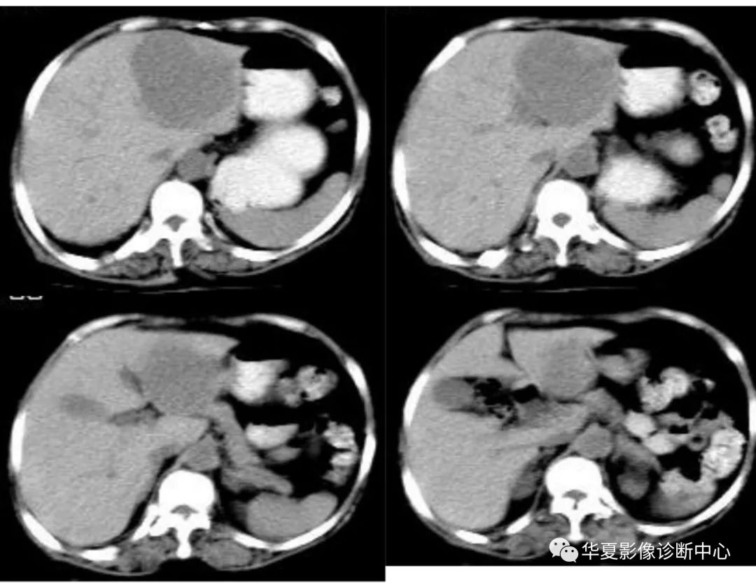 精华肝脏的ct影像诊断最全版