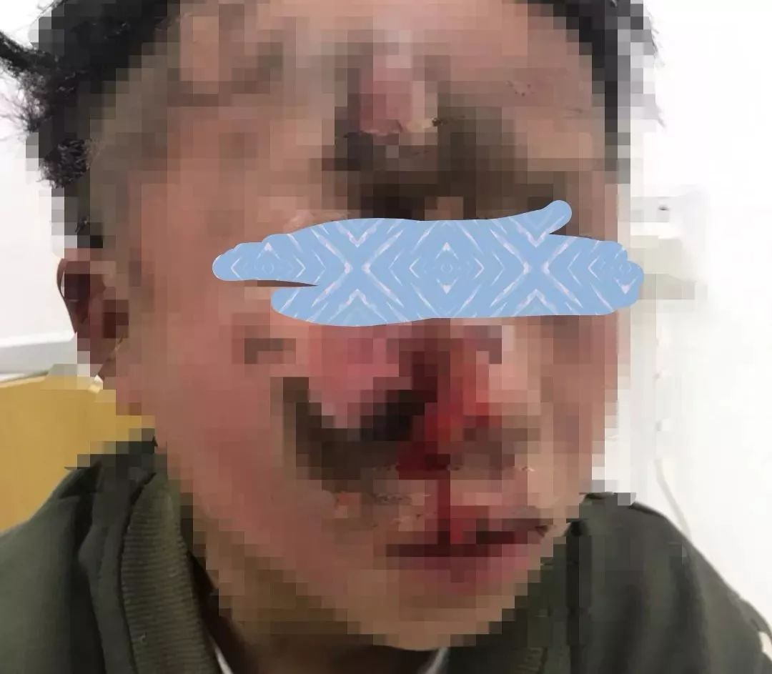 贵州一10岁男孩玩擦炮脸被炸得面目全非还有被炸断手指的