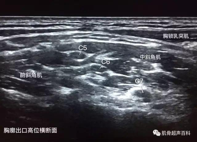 超声下臂丛神经的真面目(臂丛神经阻滞秘籍)