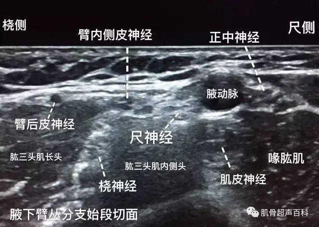 超声下臂丛神经的真面目(臂丛神经阻滞秘籍)