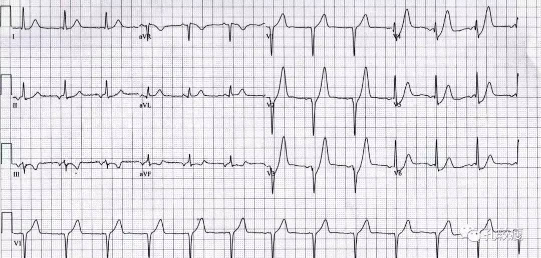 de winter综合征心电图改变被认为是一种"超急性期"改变,但超急性期这