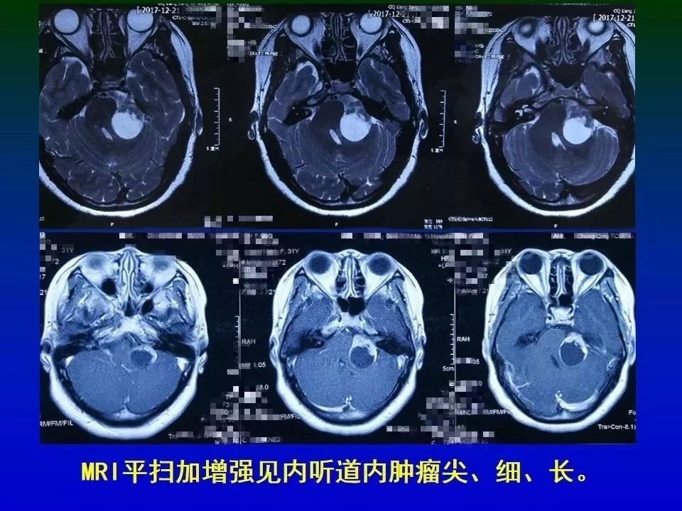 正海妙术视界钟东教授等大型听神经瘤近全切术后面神经功能保留两例