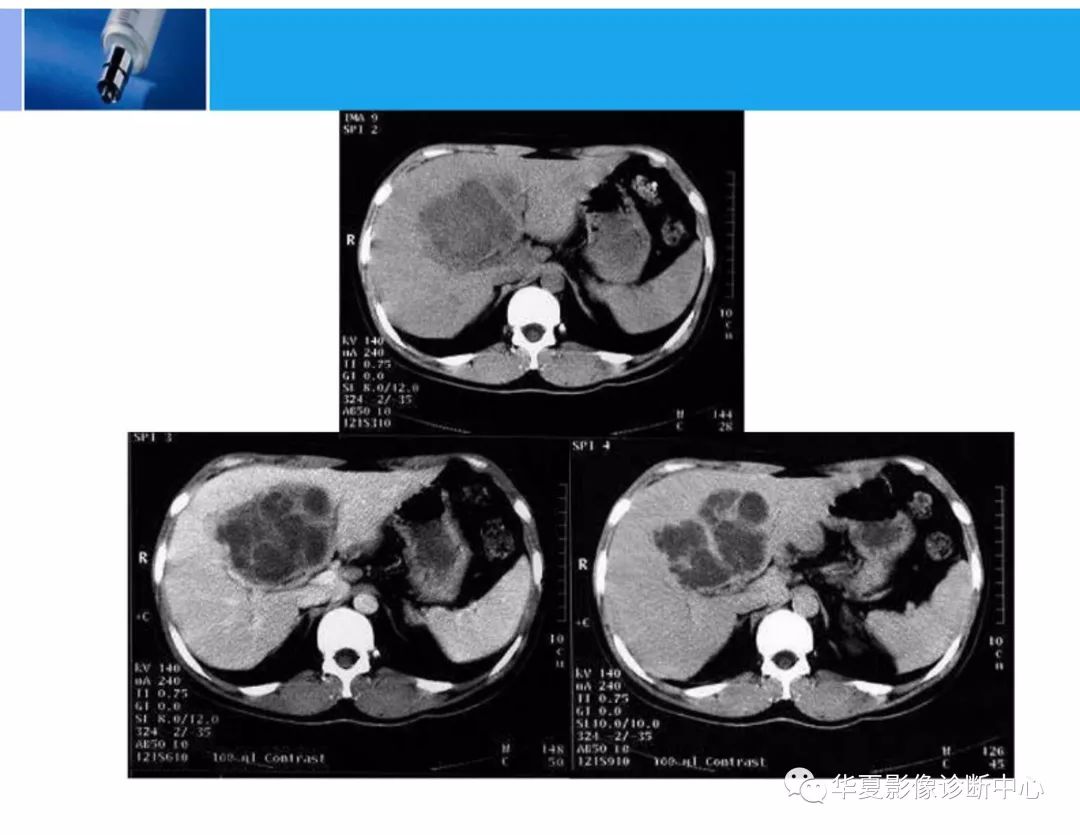 【精华】肝脏的ct影像诊断(最全版)
