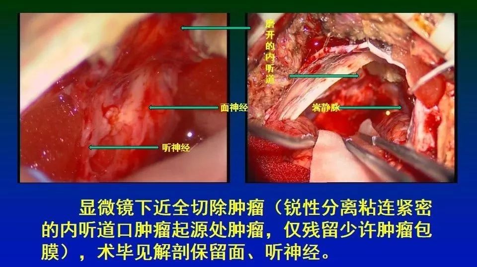 【正海-妙术视界 钟东教授等:大型听神经瘤近全切术后面神经功能