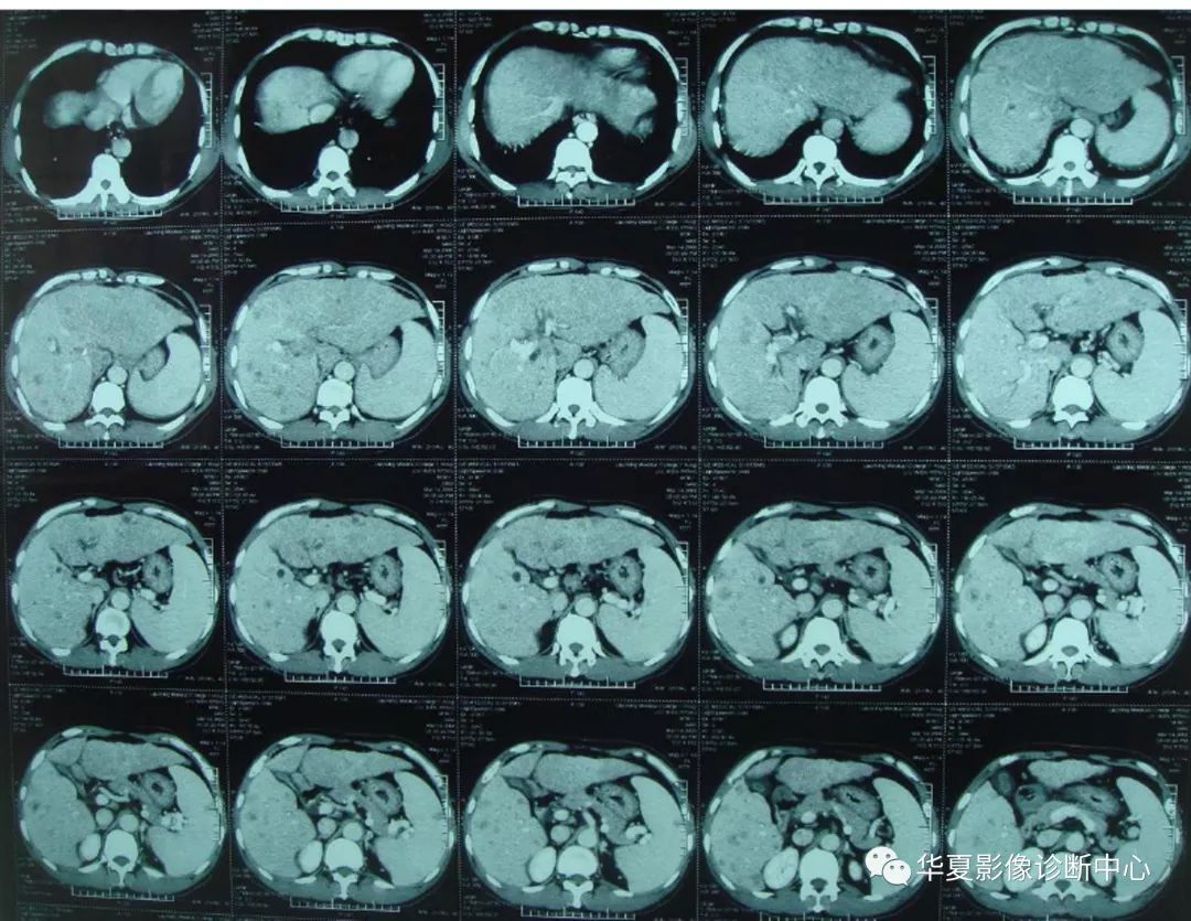 【精华】肝脏的ct影像诊断(最全版)