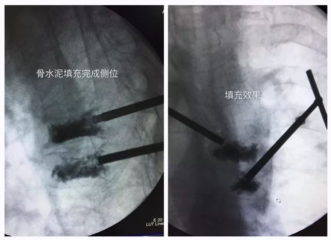 骨水泥灌注完美