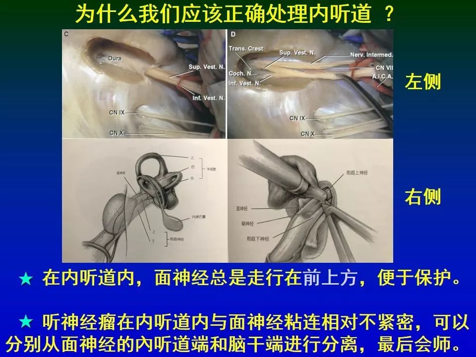 【正海-妙术视界】| 钟东教授等:大型听神经瘤近