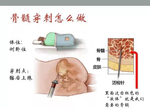 为什么要反复做骨髓穿刺?