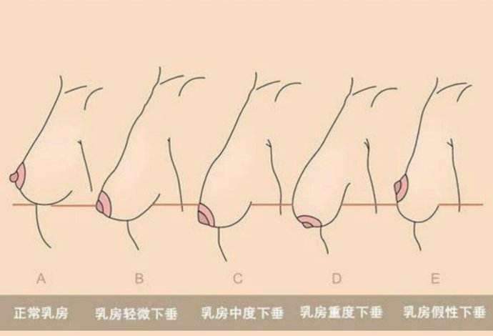 对于已经轻度下垂的乳房,可以进行局部按摩,增强胸肌的运动,比如伏地