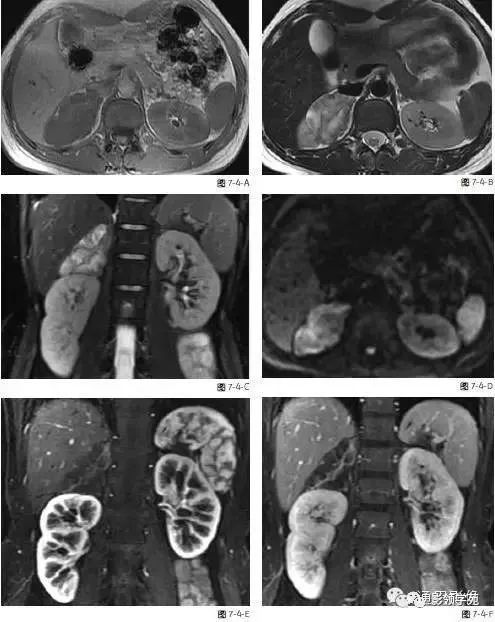 5种肾上腺肿瘤的mri表现