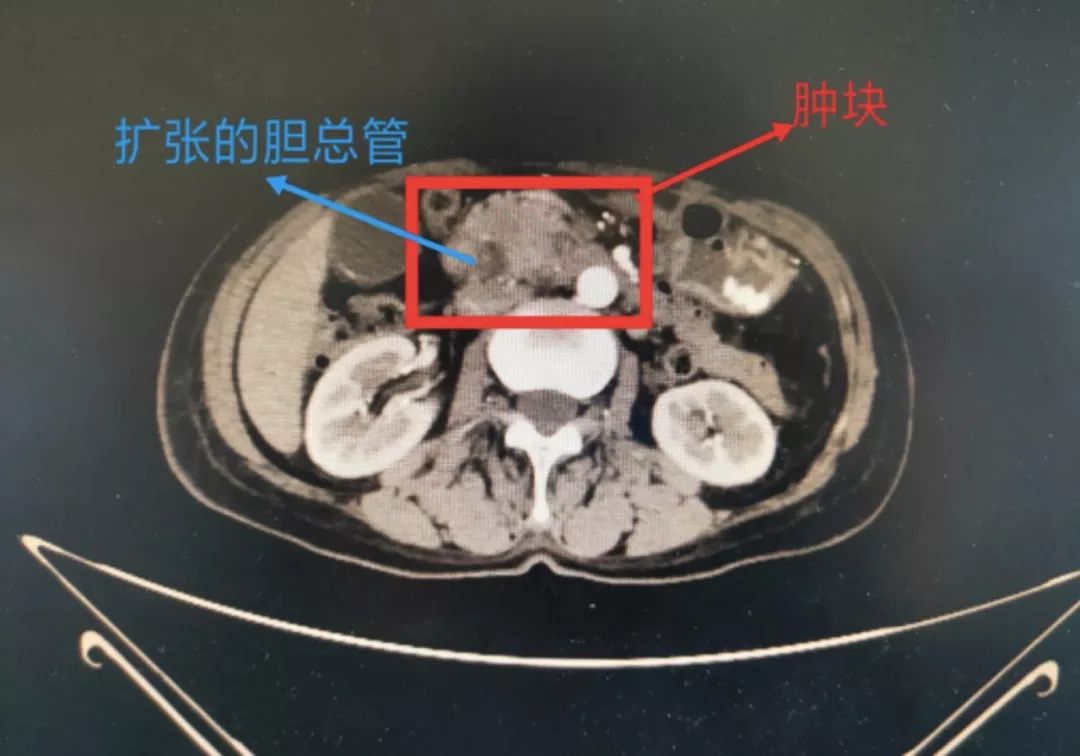 今日头条 | 树兰名医精准治疗,妙手切除胰腺癌