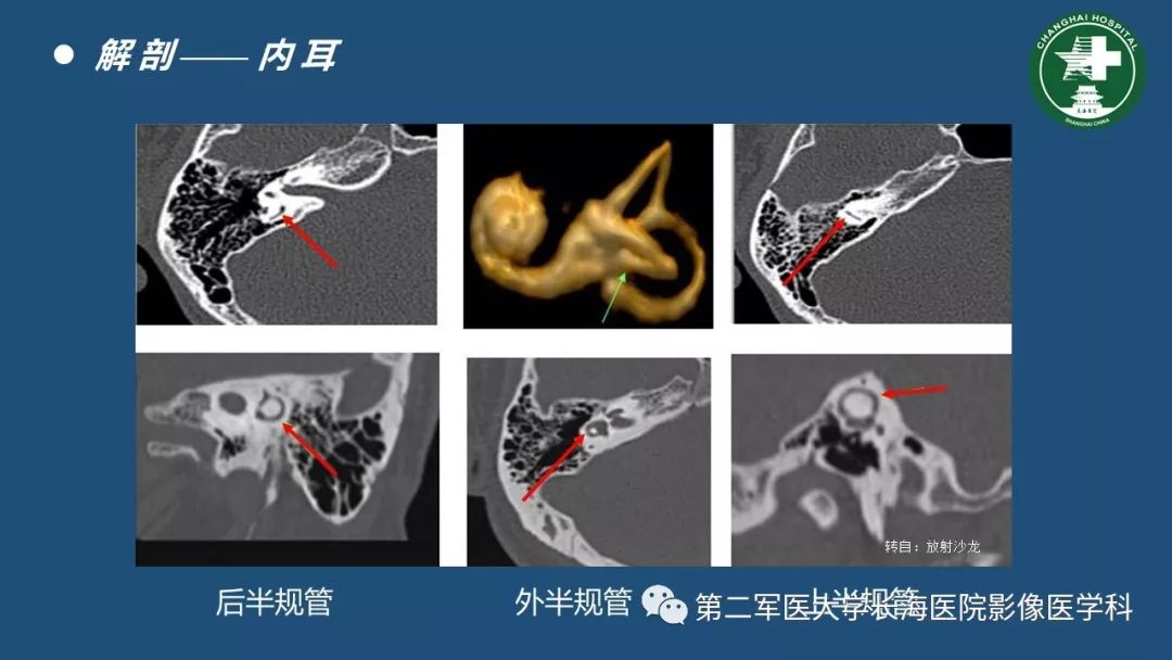 颞骨ct解剖及其常见病变