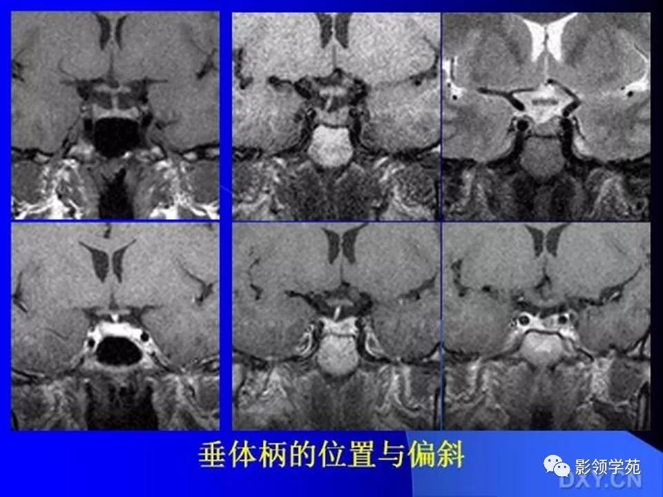 垂体瘤的mri诊断及鉴别诊断