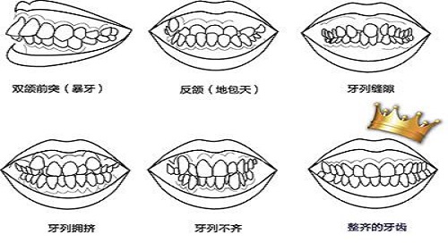 矫正牙齿怎么办