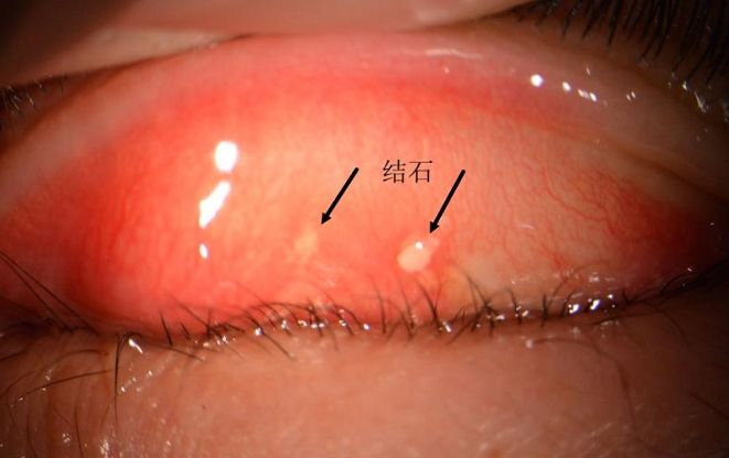多因结膜炎症引起,小的结膜结石没有症状,但当结石比较大,特别是突出