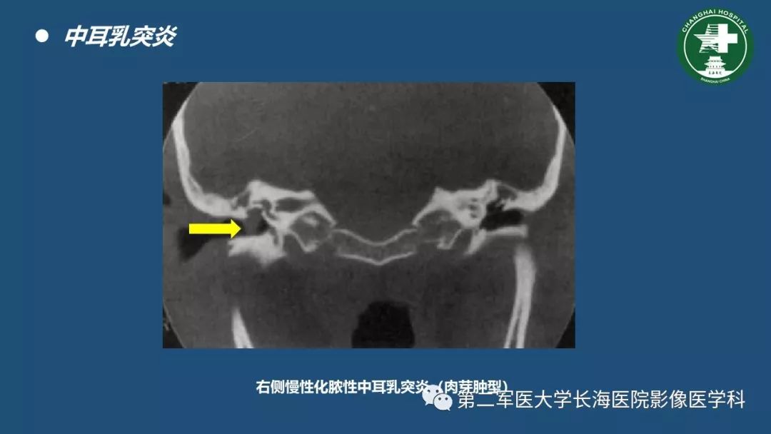 颞骨ct解剖及其常见病变