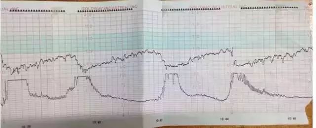 史上最全胎心监护知识点大全,值得妇产科医生和助产士收藏!