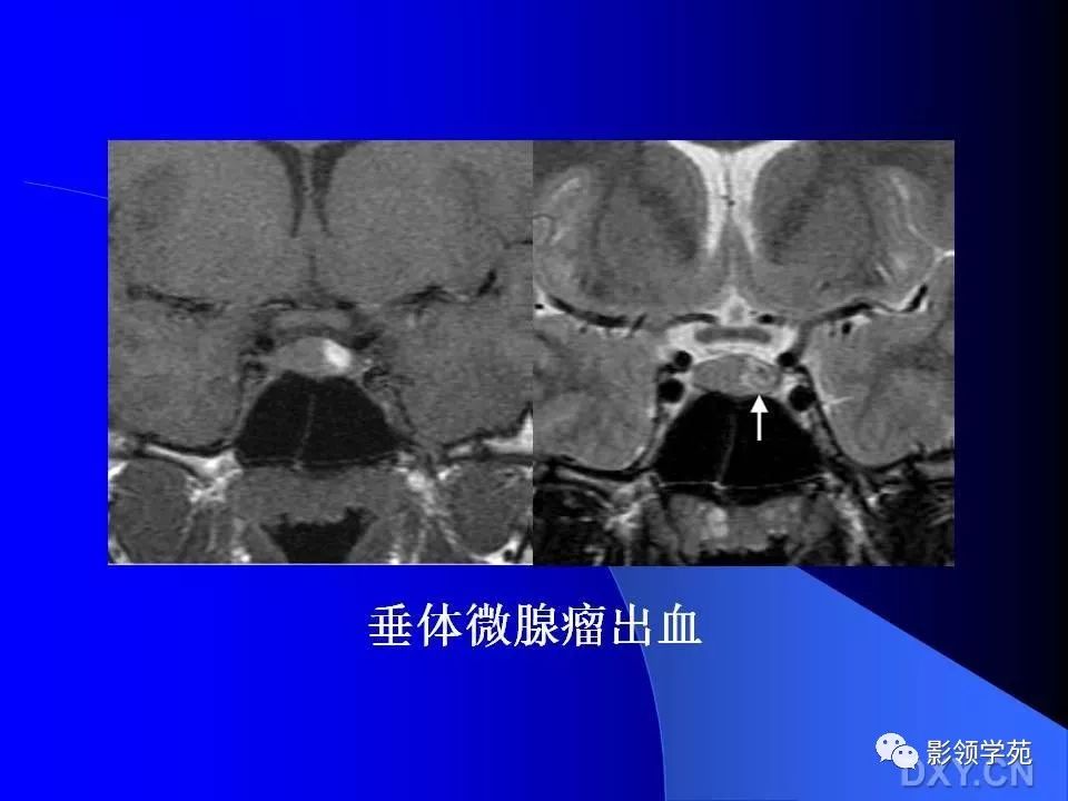 垂体瘤的mri诊断及鉴别诊断