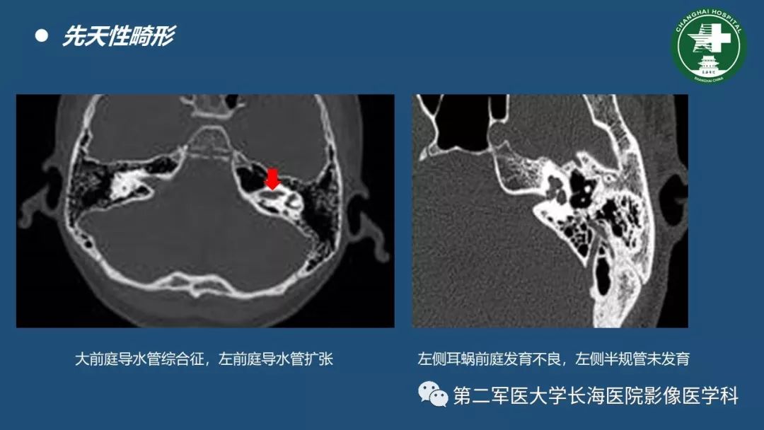 颞骨ct解剖及其常见病变