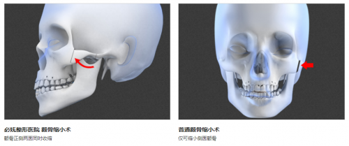 韩国必妩医院颧骨手术特点大曝光！成功率高的