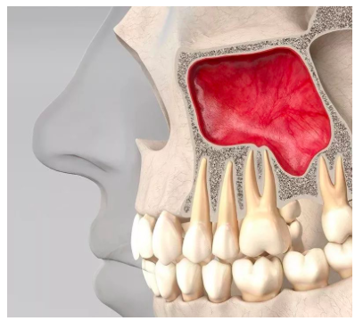 种牙时，为什么要做上颌窦提升 (转载)