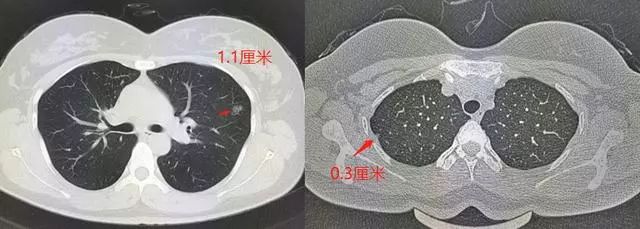 29岁姑娘查出肺结节肺腺癌医生却说幸亏她得了另外一种病